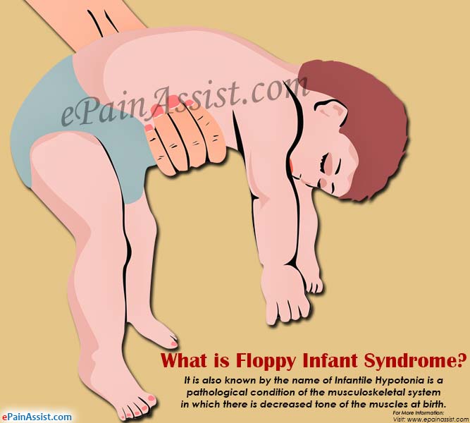 what-floppy-infant-syndrome.jpg